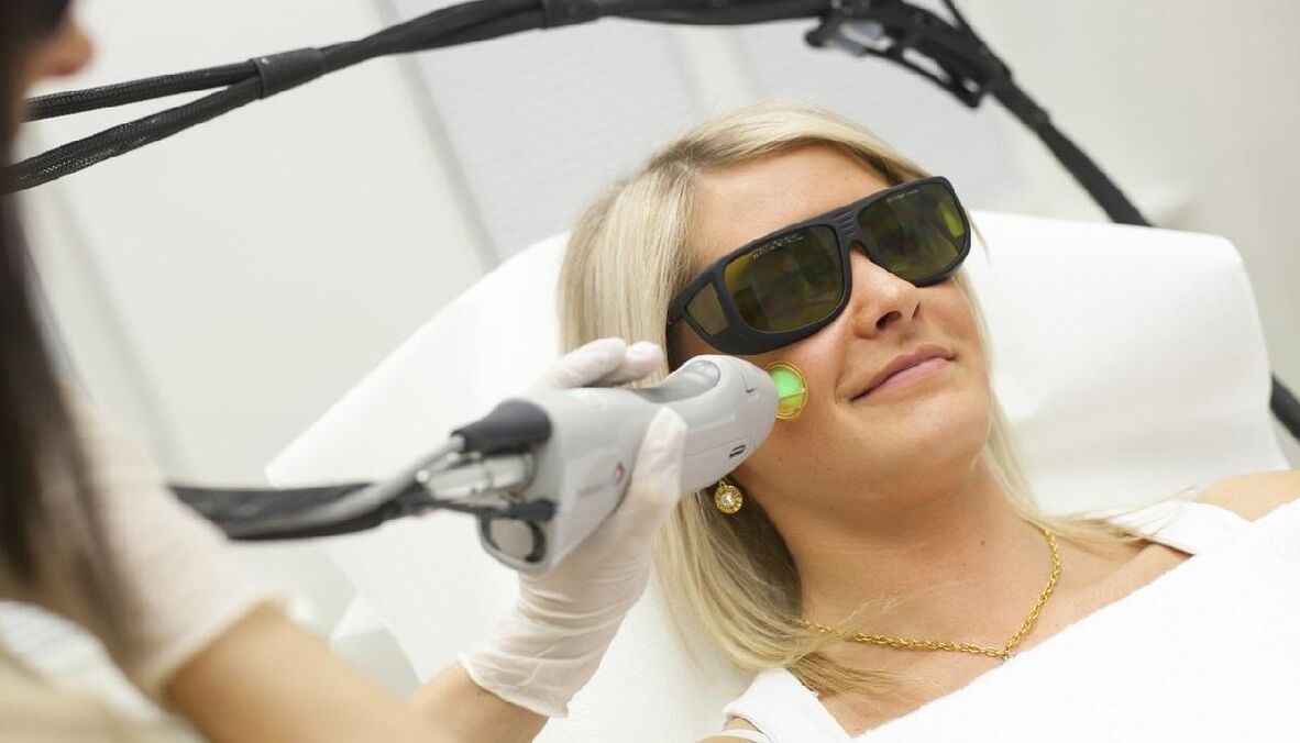 Laser gaztetzea