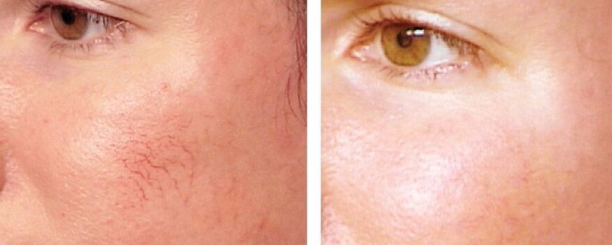 Rosacea kentzea